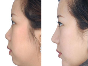 深圳非凡医院的李萍医生怎么样?李萍医生手术案例分享