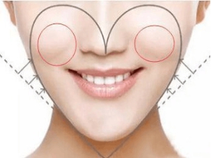 邱立东医生丰苹果肌的技术好吗?邱立东医生谈填充细节及术后