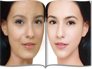 邱立东医生丰苹果肌的技术好吗?邱立东医生谈填充细节及术后