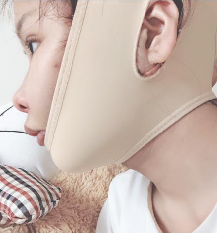 南宁美丽焦点医疗美容门诊部改脸型技术如何？附三个月的恢复对比图