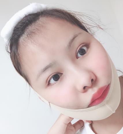 南宁美丽焦点医疗美容门诊部改脸型技术如何？附三个月的恢复对比图