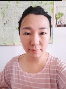 任向群医生擅长注射瘦脸的注射吗？附三个月的前后对比图