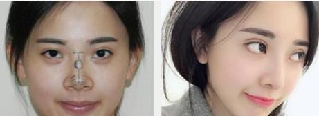 整形医生王斌简介-隆鼻果好吗?擅长项目-兰州仁和