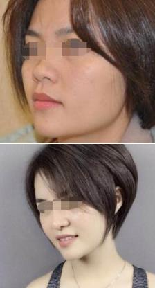 兰州仁和叶海云医生的个人简介-隆鼻案例怎么样?