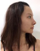 兰州明伦整形医院的面部脂肪填充做的可以吗？附三个月的前后对比图