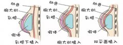重庆星辰隆胸案例果好不好?真是案例分享---价格