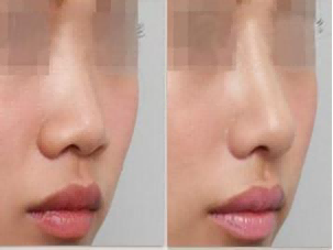 梧州华美医院隆鼻技术怎么样？真实案例分享