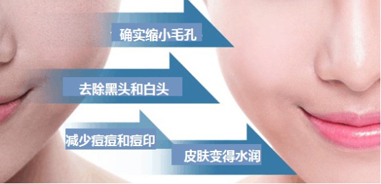 黑脸娃娃光子嫩肤怎么样?果如何?原理是啥?