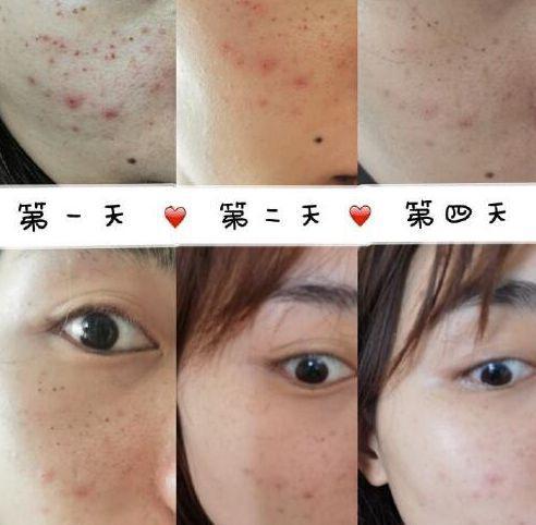 光子嫩肤哪家医院好?案例有吗?