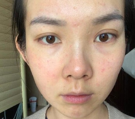 光子嫩肤哪家医院好?案例有吗?