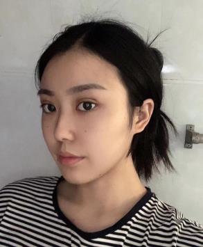 刘丽娜医生的技术怎么样？附眼部整形恢复过程