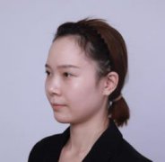 医生王丽君隆鼻怎么样？鼻部手术恢复果图