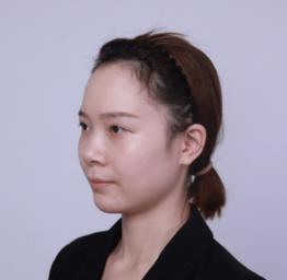 医生王丽君隆鼻怎么样?鼻部手术恢复果图