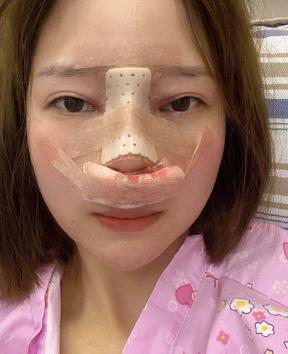 医生王丽君隆鼻怎么样?鼻部手术恢复果图