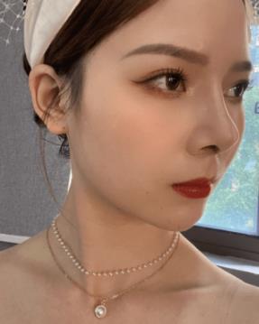 医生王丽君隆鼻怎么样?鼻部手术恢复果图