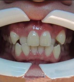 在新疆整形医院徐文飞做的牙齿矫正让我拥有了自信,附前后对比图