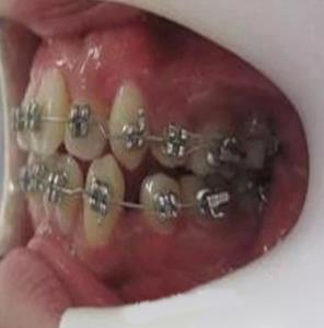 在新疆整形医院徐文飞做的牙齿矫正让我拥有了自信,附前后对比图