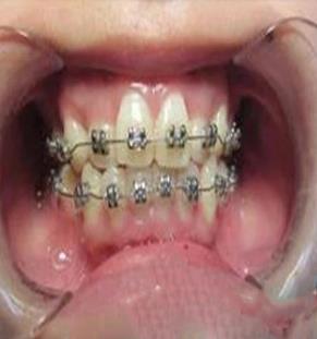 在新疆整形医院徐文飞做的牙齿矫正让我拥有了自信,附前后对比图