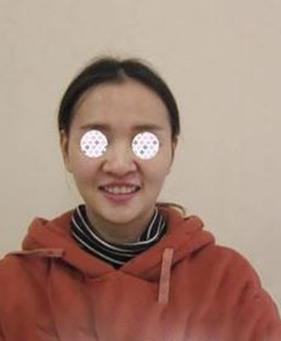 在新疆整形医院徐文飞做的牙齿矫正让我拥有了自信,附前后对比图