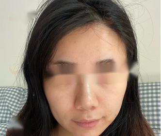 曹立铭的P丙二醇埋线提升优势是什么?有相关的实际案例吗?