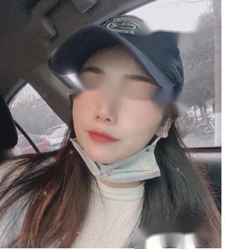 曹立铭的P丙二醇埋线提升优势是什么?有相关的实际案例吗?