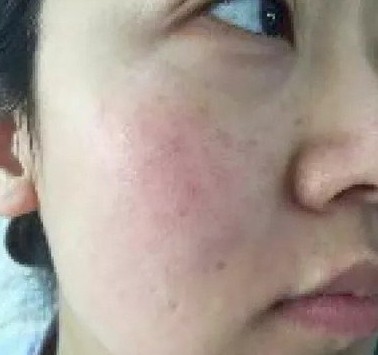 光子嫩肤果好吗?2例案例前后对比图