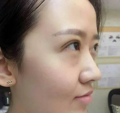 光子嫩肤果好吗?2例案例前后对比图