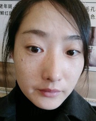 光子嫩肤果好吗?2例案例前后对比图