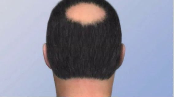 苏州的植发费用高吗?有什么因素影响价格?推荐医院有哪些?