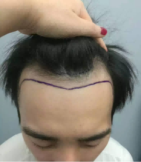 苏州的植发费用高吗?有什么因素影响价格?推荐医院有哪些?