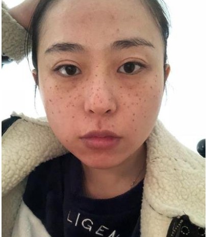整形专家李瑞芬怎么样?李瑞芬医生案例分享