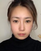 广州美恩磨骨手术可以做吗？磨骨一年后对比照片