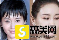 明星整容脸部僵硬是事实吗？经过调查我在苏州圣爱医院做了面部脂肪填充