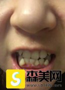 马晓辉医生牙齿矫正需要多久时间？附矫正前后对比