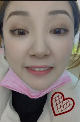 在上海华美做的脸部磨骨手术恢复需要多久?附恢复过程照片