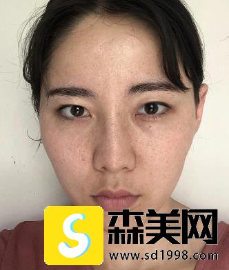 整形医生刘先超所做的眼部手术如何？附术后三个月恢复记录