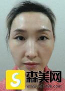 李志海的玻尿酸填充手术怎么样？附果图浏览