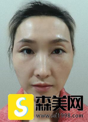 李志海的玻尿酸填充手术怎么样?附果图浏览