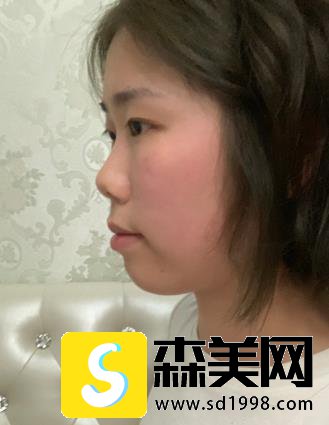 上海李湘源医生双眼皮果图好吗?手术70天对比图