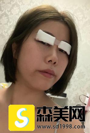上海李湘源医生双眼皮果图好吗?手术70天对比图