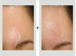 在李爱兵教授那做的祛疤，可算让我和这陪了我20年的疤痕说再见了！