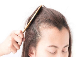 武汉恩吉娜的廖静医生的植发际线要多少?附植发案例和较新植发价目表