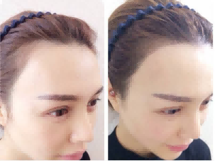 武汉恩吉娜的廖静医生的植发际线要多少?附植发案例和较新植发价目表