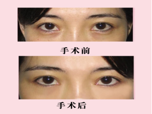 袁伟医生做手术怎么样?袁伟医生整容案例