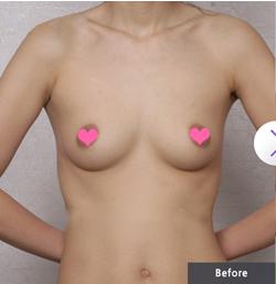 武汉隆胸就找袁伟医生！袁伟医生隆胸真实案例分享