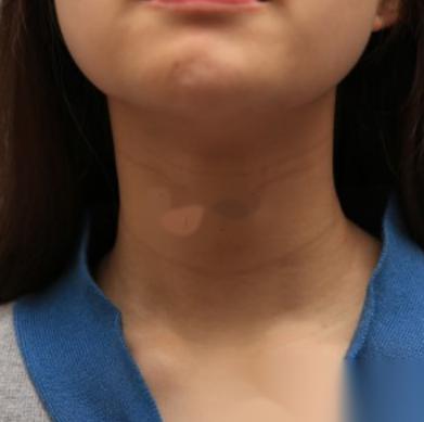 在伍远红医师那做的延缓衰老,四十岁的人好似二十岁般年轻!