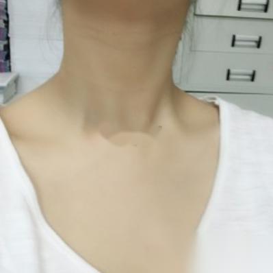 在伍远红医师那做的延缓衰老,四十岁的人好似二十岁般年轻!