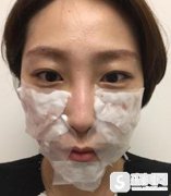 南京医科大学第二附属医院的玻尿酸填充果可以吗？术后30天恢复日记