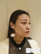 南宁隆鼻焦俊光名声怎么样?鼻部手术恢复果图浏览