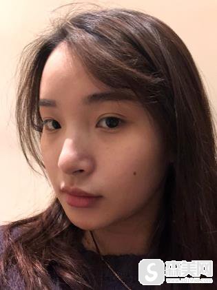 南宁隆鼻梦想医院果怎么样?附隆鼻前后对比